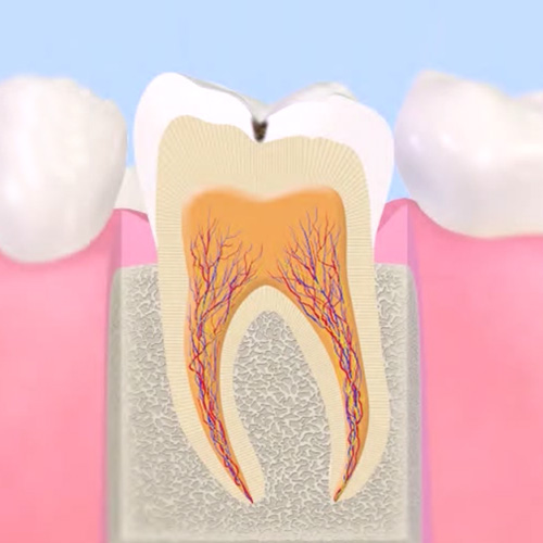 初期のむし歯（C1）