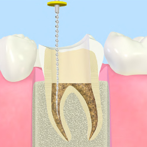 歯の根の治療